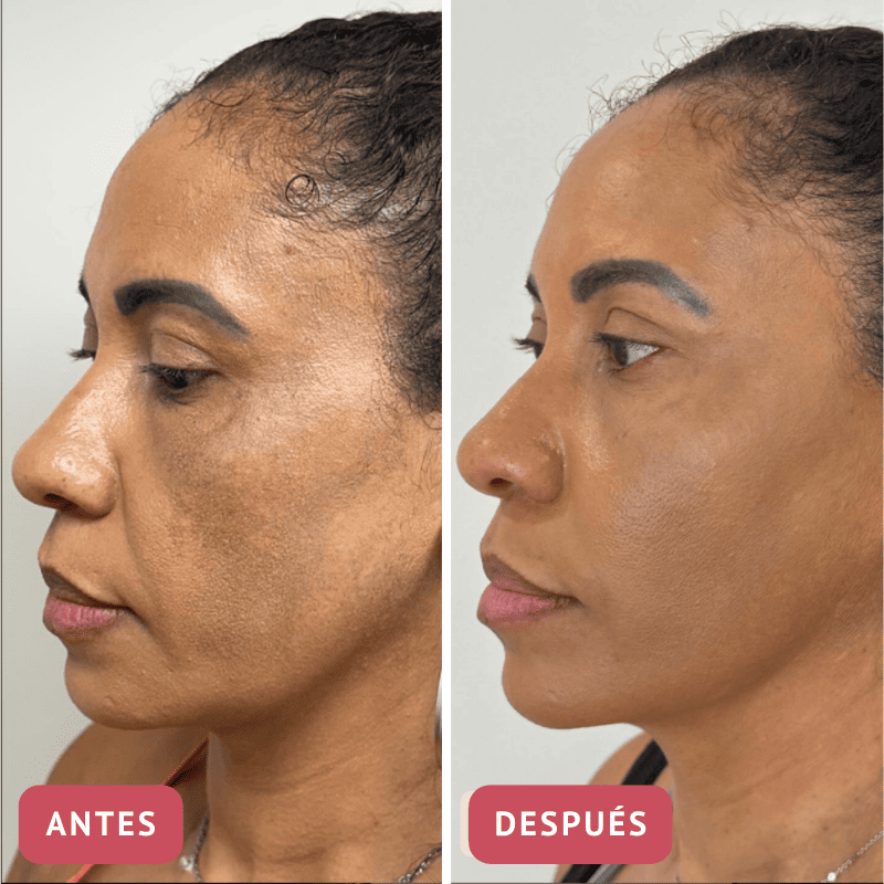 Collagen Skin™ – Mascarilla antiedad con efecto lifting